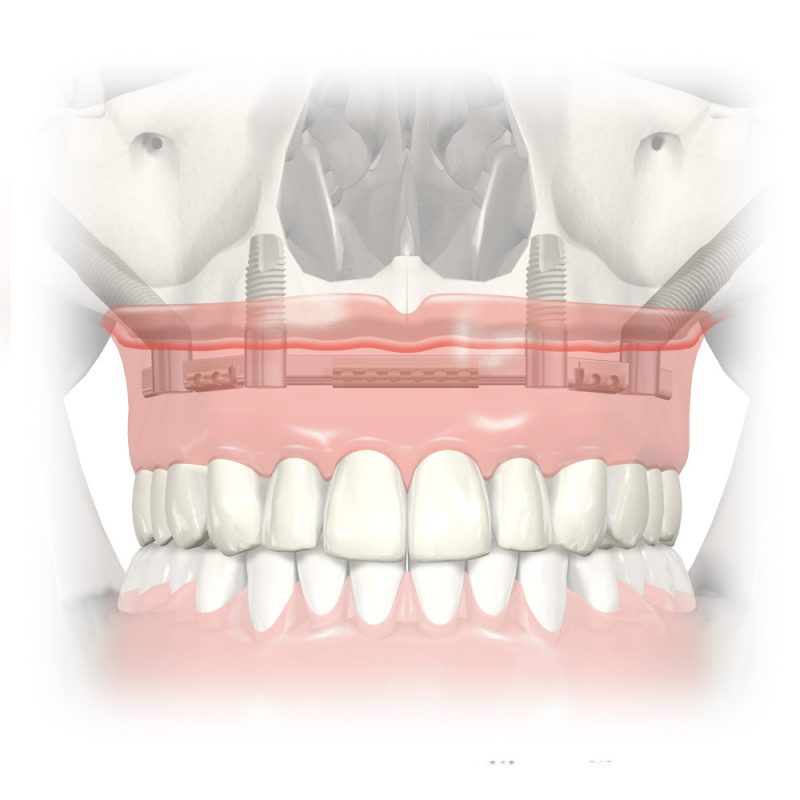 Zygomatic Implants Arnica Zygomatic Dental Implants