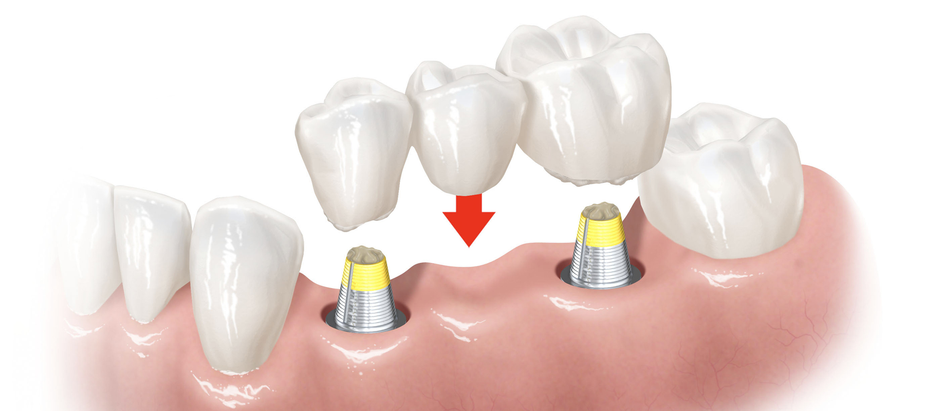 Implant Retained Bridges And Dentures Arnica Dental Care 9891